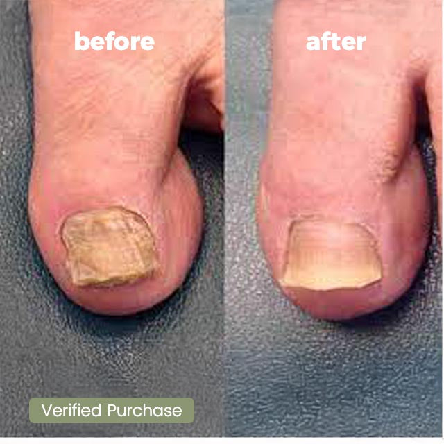 Purifyd NailCure+ Natural Ointment