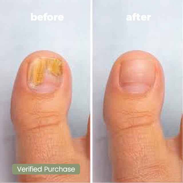 Purifyd NailCure+ Natural Ointment