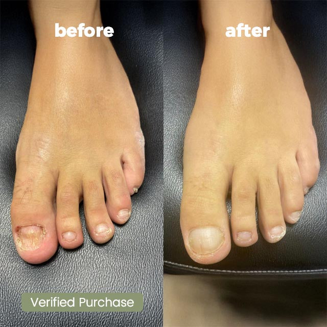 Purifyd NailCure+ Natural Ointment